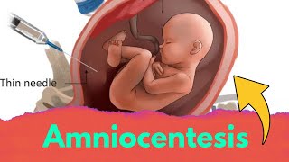 Amniocentesis class 12 biology  Amniocentesis test [upl. by Eeznyl]