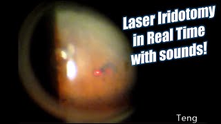 Laser Iridotomy in Real Time with Laser Sounds Chris Teng MD [upl. by Ingles]