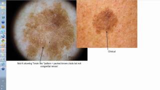 Dermoscopy Made Simple  Seborrhoeic Keratoses [upl. by Ancel895]