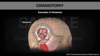 Craniotomy [upl. by Newberry]