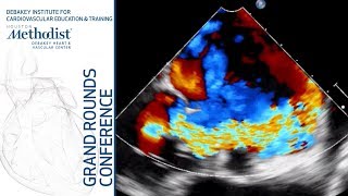 Mitral Regurgitation State of the Art Management Colin Barker MD January 31 2019 [upl. by Wedurn]