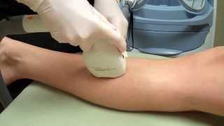 LightSheer Duet Laser Hair Removal on a Womans Legs [upl. by Neelhtak]