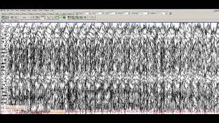 Learn to Read EEGs Part 3 [upl. by Alyal691]