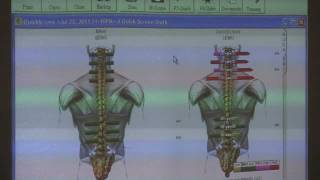 Chiropractic Adjustment Surface EMG Scans amp Spinal Alignment by Dr Madden [upl. by Jeanine325]