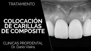 Carillas de composite en Propdental [upl. by Annayak]