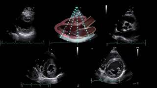 〖Echocardiography〗 Parasternal long axis view amp corresponding parasternal short axis 🫀📖 [upl. by Ogeid]