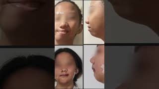 Filipina teen receives major facial reconstruction surgery in Scotland [upl. by Tayler]