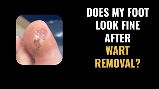 What should my skin look like after a wart removal [upl. by Genesa]