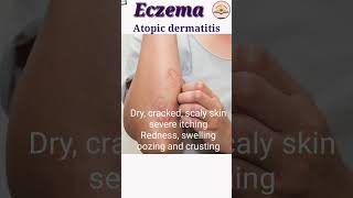 allergic skin diseases  skin diseases name symptoms shorts [upl. by Ahsiekin]