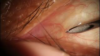 Cyst Incision amp Drainage on Bulbar Conjunctiva Eye [upl. by Nassir156]