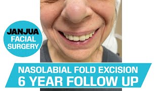 NASOLABIAL FOLD EXCISION 6 YEAR FOLLOW UP  DR TANVEER JANJUA  NEW JERSEY [upl. by Adihsaar781]