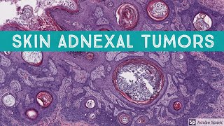 Skin Adnexal Tumors Dermatopathology Unknown Cases [upl. by Tebazile575]