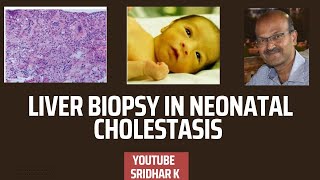 Liver biopsy to diagnose biliary atresia liverbiopsy histopathology biliaryatresia [upl. by Llertnac225]