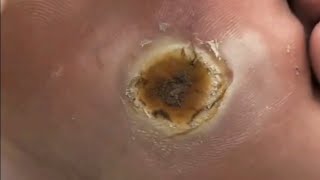 Pedicure video 41，vertical plantaris，plantar wartfeet [upl. by Auliffe]