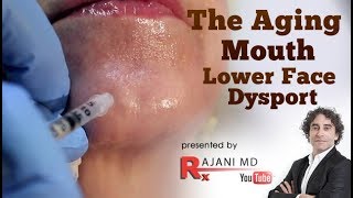 The Aging Mouth Dysport Injections Lower Face [upl. by Ainoek958]