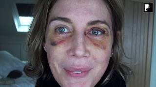 Blepharoplasty Video Diary  Day 7 After Surgery 6 of 15 [upl. by Ayahc57]