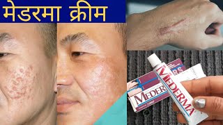 Mederma Skin care For ScarsMederma cream Remove Acne Scarssurgery scarsburn scarsstretch mark [upl. by Alcina]