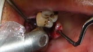 PeriImplantitis with LIGHTMEDs SAPPHIRE Laser [upl. by Nidraj]