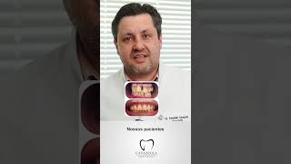 Implantes Dentários [upl. by Htebarual]