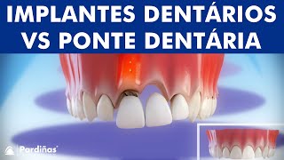 Implantes Dentários VS Ponte Dentária  Comparação © [upl. by Trebliw]