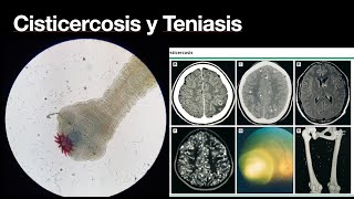 Cisticercosis y Teniasis intestinal  Conoce la enfermedad  Parasitos [upl. by Uriisa]