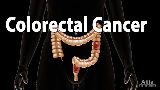 Colon Cancer Pathology Symptoms Screening Cause and Risk Factors Animation [upl. by Jamey]