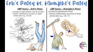 Erb Duchennes palsy and Klumpkes palsy differences Anatomically and Clinically [upl. by Wixted]