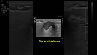 Parotid gland mass 1 imaging ultrasound radiology salivaryglands cases [upl. by Amitaf]