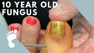 Fungus Takes Over Toenail  Toenail Removal [upl. by Notnil865]