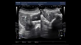 Retained products of conception RPOC after D amp C [upl. by Llewej309]