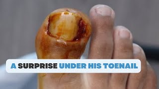 WHAT IS THIS SURPRISE UNDER HIS TOENAIL [upl. by Eenel]