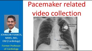 Pacemaker related video collection [upl. by Ahcas896]