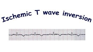 Mechanism of ischemic T wave inversion [upl. by Renmus]