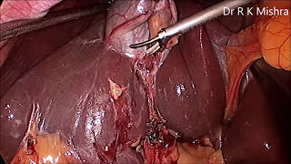 Gallbladder Stone Surgery [upl. by Ecitnerp568]