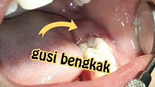 Gusi bengkak karena gigi tumbuh operasi bedah kecil Sakit gigi Info kesehatan Jogja [upl. by Linnette637]