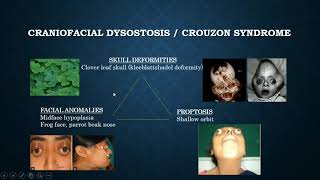 Brief discussion on Crouzon syndrome [upl. by Rudolfo]