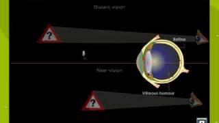 Defects Of Vision1 [upl. by Whittaker]