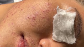 Blackheads amp Pimples Pore Removal New 2024  Acne Treatment With Bo Nguyễn Spa 027 [upl. by Enilhtak]