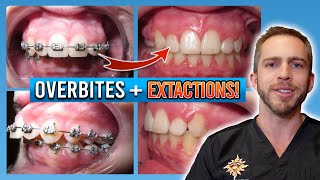 Braces Overbite Treatment BEFORE amp AFTER [upl. by Sitoeht]