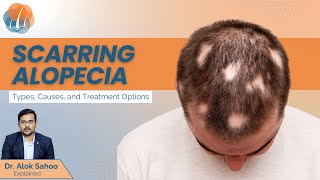 What is scarring alopecia  Types Causes Diagnosis and treatment options  Dr Alok Sahoo [upl. by Legnaros783]