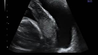 Ultrasound in Cesarean Scar Pregnancies amp Placenta Accreta Spectrum  ISUOG Education Course [upl. by Kendy909]