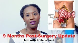 9 Months PostSurgery Update I Life with Crohns Ep 5 [upl. by Anilak482]