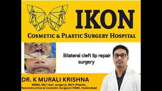 Bilateral cleft lip repair surgery [upl. by Anirbac67]