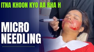 Micro needling krva li aaj😳 simmipunia vlog dailyvlog microneedling openporestreatment [upl. by Kilby494]