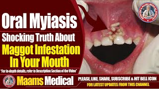 Oral Myiasis  Shocking Truth About Maggot Infestation In Your Mouth  Maams [upl. by Aiket851]