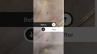 Skin tag removal by electrocautery  painless and bloodless removal [upl. by Llertnom300]