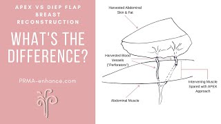 APEX vs DIEP Flap Breast Reconstruction  Whats the Difference [upl. by Calle258]