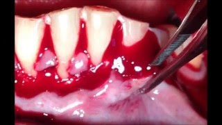 GINGIVAL RECESSIONCORONALLY REPOSICIONED FLAP WITH PLATELED RICH FIBRINE PRF Esp BRITTO FALCON [upl. by Yggam]