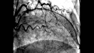 Acute anteroseptal myocardial infarction [upl. by Marty]