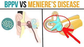 BPPV vs Menieres Disease Whats the Difference amp How to Improve [upl. by Courtenay]